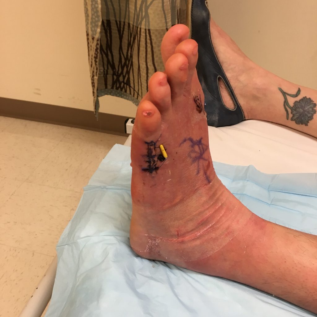 That yellow thing? That's a cap on the pin sticking out of my foot!